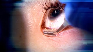 Watch as Woman Undergoes Procedure to Remove Eyelid Puss [upl. by Alodi908]