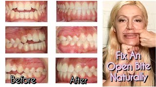 How To Fix An Open Bite Naturally No Braces No Surgery [upl. by Docile]