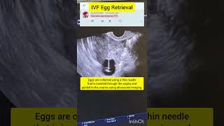 Is IVF Egg Retrieval painful  infertilitytreatment ivf drrakshitamalik ivfprocess ivfjourney [upl. by Annoerb]