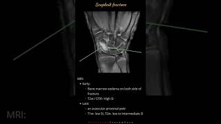 Scaphoid fracture  Wrist bone fractures  Radiology tutorials by Radiology Everywhere [upl. by Kaasi768]