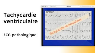 Tachycardie ventriculaire  ECG pathologique  arythmie [upl. by Gothart]