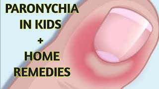 paronychia treatment and home remedies english  paronychia [upl. by Seidel]