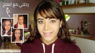 My Vitiligo Story  رحلتي مع العلاج [upl. by Siulesoj]