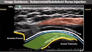 Webinar UltrasoundGuided Shoulder Injections Part 1 [upl. by Ietta]