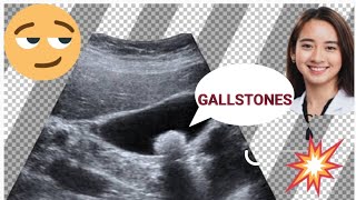 Gallstones sign symptoms l Asymptomatic gallstones l 🔥🔥😟 [upl. by Kopaz]