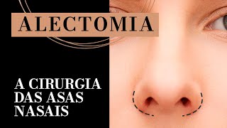 Alectomia Redução da Asa Nasal na Rinoplastia  Dr Fábio Maniglia [upl. by Ynnej]