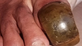 Extreme Toenail Transformation Cutting Wild amp Smelly Toenails [upl. by Landmeier304]