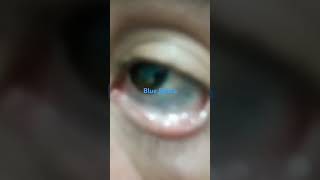 Unveiling the Mystery of Blue Sclera [upl. by Ivo]