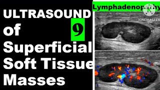 Lymphadenopathy [upl. by Bikales]