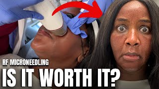 I Got RF Microneedling Again and THIS Happened Black Skin [upl. by Statis]