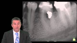 19700 Retreatment in Endodontics  From Difficult to Complicated Cases PREVIEW [upl. by Stempien]