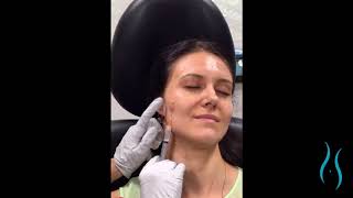 Sculptra Injections in Connecticut [upl. by Garold]