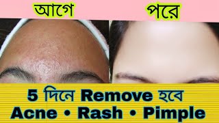 How to remove  Acne Rash Pimple  100 work  DIY Homeremedy [upl. by Brien]