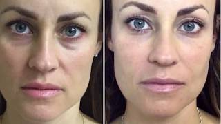 Dermal Filler Under Eyes Tear Trough [upl. by Tegdig]