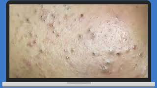 Punti Neri Acne Blackheads Removal pt2 [upl. by Pompei]