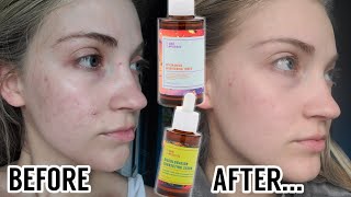 I Tried The Good Molecules Niacinamide Toner amp Discoloration Correcting Serum For 2 Months [upl. by Gnouhk526]