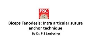 Biceps Tenodesis Intra articular suture anchor technique By Dr P S Laubscher [upl. by Booth]