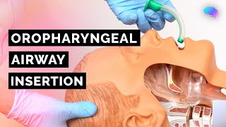 Oropharyngeal Airway Insertion  Guedel  OPA  ABCDE Emergency  OSCE Guide  UKMLA  CPSA [upl. by Nylakcaj]