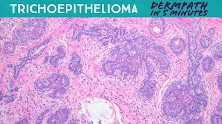 Trichoepithelioma  a hair follicle tumor Dermpath in 5Minutes pathology dermatology [upl. by Annaj]