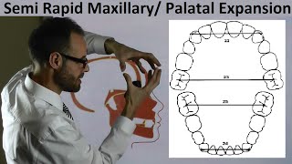 Mechanism of Semi Rapid Palatal Maxillary Expansion amp Teeth Position on Arches by Dr Mike Mew [upl. by Richmond933]