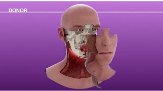 Cameron Underwood Face Transplant Surgical Animation 2018 [upl. by Leur679]