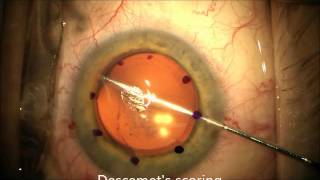 Descemets Stripping Automated Endothelial Keratoplasty DSAEK [upl. by Celisse967]