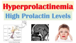 Prolactin Test  প্রোল্যাক্টিন পরীক্ষা [upl. by Eneleahs784]