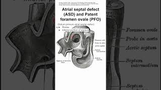 Atrial septal defect ASD and Patent foramen ovale PFO [upl. by Dace868]