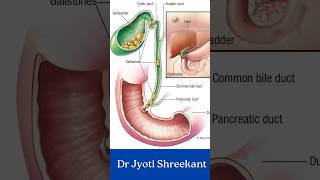 Gallbladder stone symptoms shorts [upl. by Aihcela]