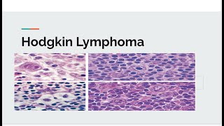 Hodgkin lymphoma [upl. by Mohandis825]