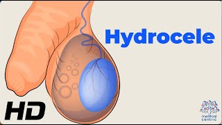 Dealing with Hydrocele Understanding the Condition and How to Manage It [upl. by Ettedualc923]