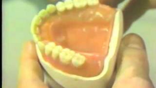 Waxing the Complete Denture [upl. by Mihcaoj]