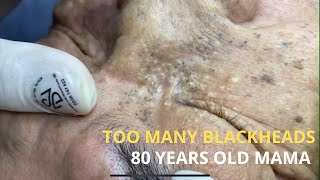 Too many Blackheads On 80 Years Old Face  Acne Treatment Nhat Bang 2024 [upl. by Imak593]