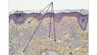 2 new dermoscopic criteria for LMM on the face by Dr Luc Thomas [upl. by Mcallister173]