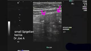 Spigelian hernia ultrasound video [upl. by Perretta972]