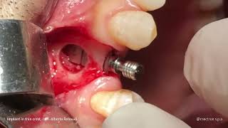 IMPLANTOLOGY  REX  Dr Alberto Rebaudi  Implant in thin crest [upl. by Alika252]