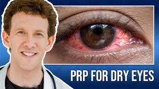 PRP Treatment for Dry Eyes with Dr Scheiner  Karas Testimonial [upl. by Cecilio723]