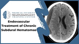 Endovascular Treatment of Chronic Subdural Hematomas [upl. by Ennairrac]