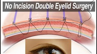 NonIncisional Asian Double Eyelid Surgery Suture Technique for Monolid Correction Animation [upl. by Rebm]