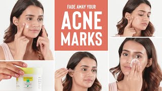 ACNE MARKS We have the ultimate solution for CLEAR SKIN [upl. by Coltson215]