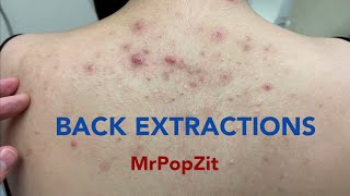 Tons of blackheads on the back Acne extractions Blackheads and whiteheads Mining pore dirt [upl. by Eetsim]