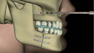 Çift Çene AmeliyatıUpper and Lower Jaw Surgery [upl. by Reeher]