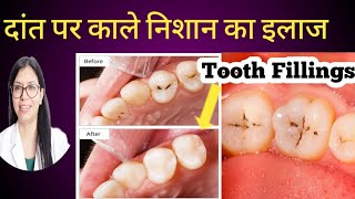 दांत पर काले निशान लग गए है Tooth cavity  Dental cavity Treatment  Tooth fillings [upl. by Aicele]