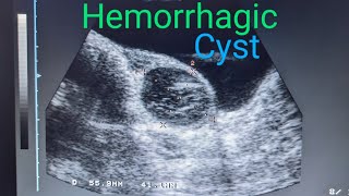 Ovary Hemorrhagic Cyst medicalimagingbyzubair ultrasound [upl. by Devin]