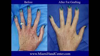 Hand Rejuvenation Before and After [upl. by Walther938]