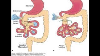 pediatric surgery GI disorders meconium ileus midgut malrotation د عامر الخزاعي [upl. by Ulick]