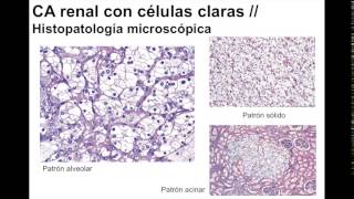 Carcinoma de células renales [upl. by Arola]