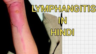 Acuteamp chronic lymphagitis in hindi  Cause  symptom [upl. by Tserof]