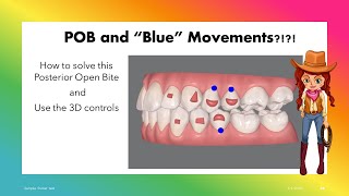 Invisalign ClinCheck  Solve Posterior OpenBite with 3D controls [upl. by Hibbs]