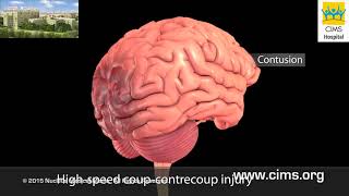 Mild Traumatic Brain Injury Hindi  CIMS Hospital [upl. by Nemlaz]